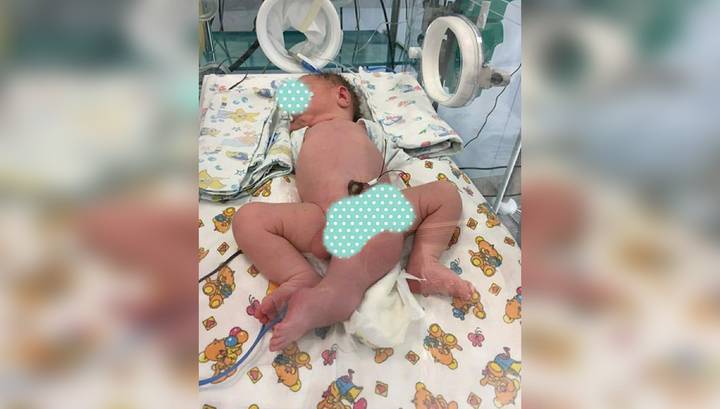 Московские врачи сделали очередную операцию малышу, родившемуся с тремя ногами