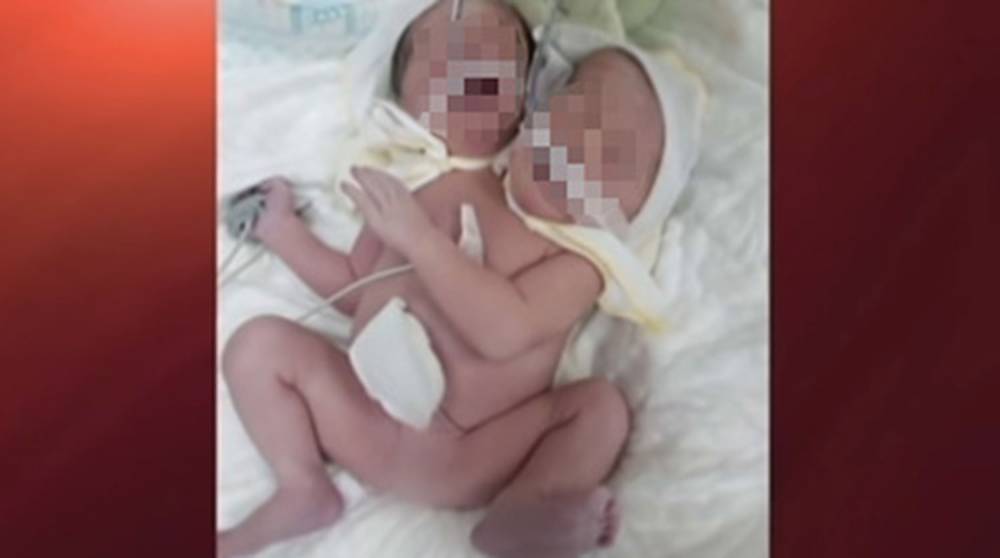 Появилось фото двухголового ребенка, который родился на Украине