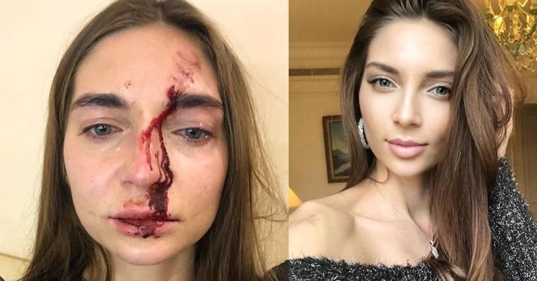 Избитая в московской клинике певица показала на видео сломанный нос
