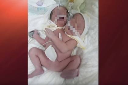 Опубликовано фото рожденного с двумя головами ребенка на Украине