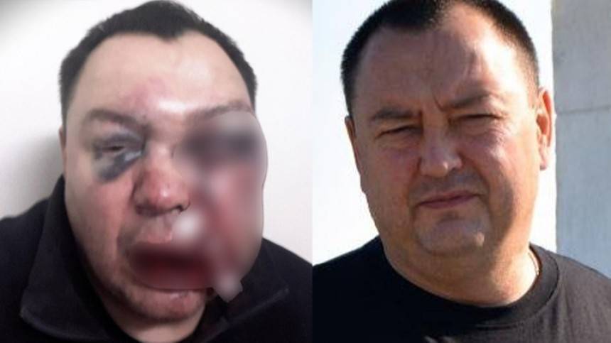 «Чистый заказ»: Избитый оппонент Иркутского губернатора рассказал, кого подозревает в нападении на себя