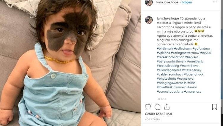 Малышка из США с «маской Бэтмена» ждет вторую операцию в России
