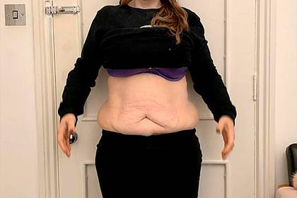 Женщина похудела на 70 килограммов и пожалела