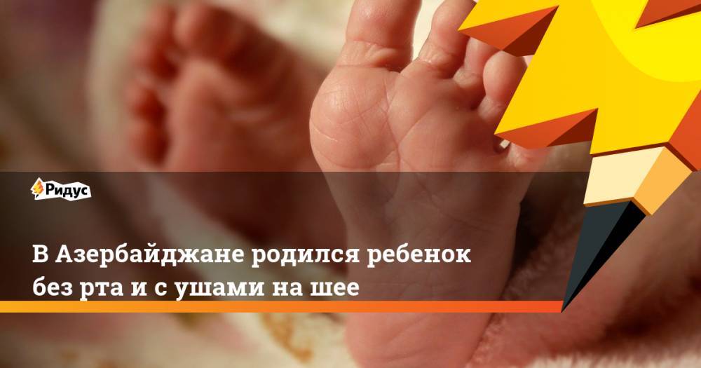 В Азербайджане родился ребенок без рта и с ушами на шее