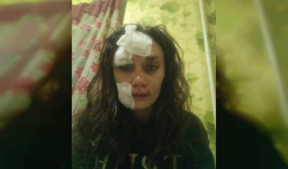 Девушка из Урюпинска поделилась, как бывший муж «розочкой» изуродовал ей лицо