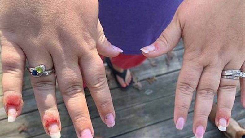 Женщина показала, во что грибок превратил ее руки после маникюра с пудрой