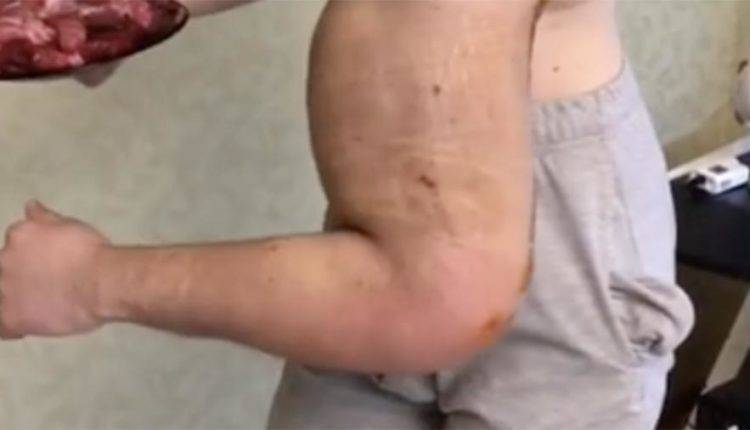 «Руки-базуки» показал свои бицепсы после операции