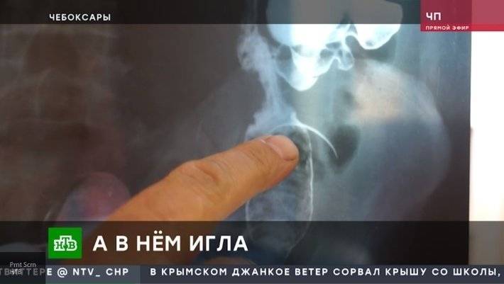 Врачи, удаляя апендикс, оставили в животе россиянина медицинскую иглу