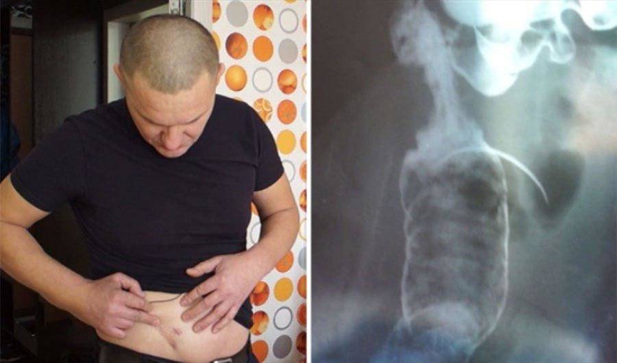 Россиянин 17 лет прожил с иглой в животе, оставленной хирургами