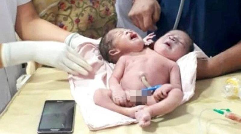 Женщина потеряла сознание от шока, когда родила ребенка с двумя головами и тремя руками (видео)