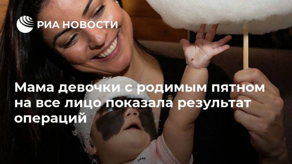 Мама девочки с родимым пятном на все лицо показала результат операций