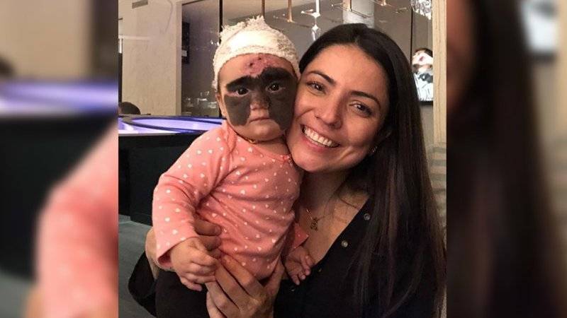 Американской девочке с родимым пятном на все лицо сделали операцию в Краснодаре