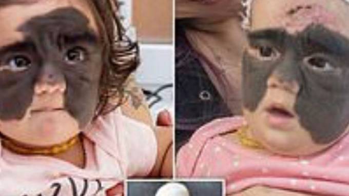 Мама девочки с родимым пятном на все лицо показала результат операций в Краснодаре
