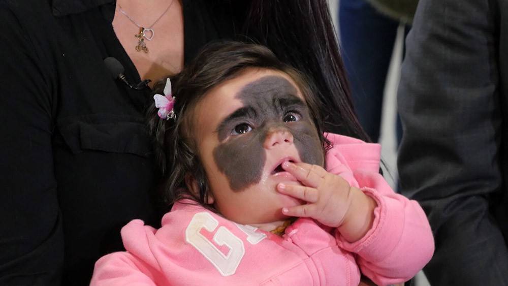 Мама девочки "с маской Бэтмена" показала дочь после операции в России