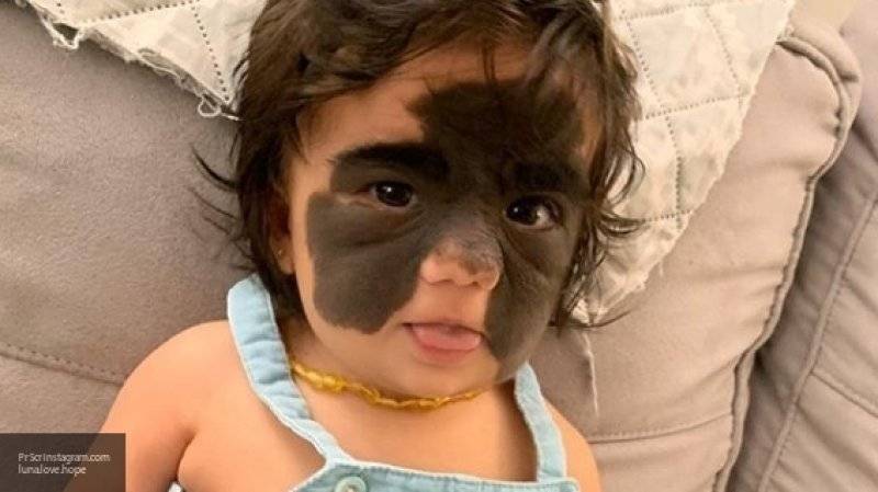 Мать девочки с "маской Бэтмена" показала дочь после операций в российской клинике