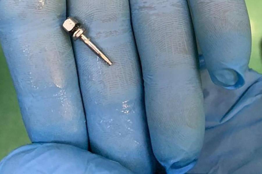 Подмосковные врачи извлекли из бронхов пациентки стоматологический ключ