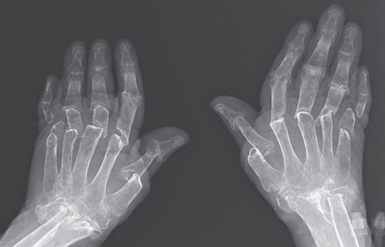 К турецким врачам пришла пациентка с раздвижными пальцами рук