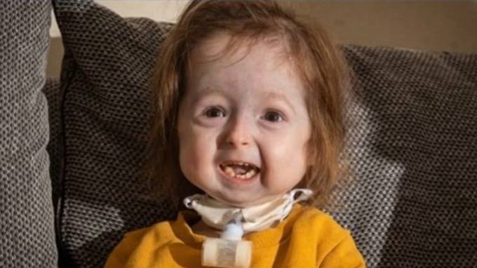 В Британии у 2-летней девочки обнаружили редкую болезнь "Бенджамина Баттона"