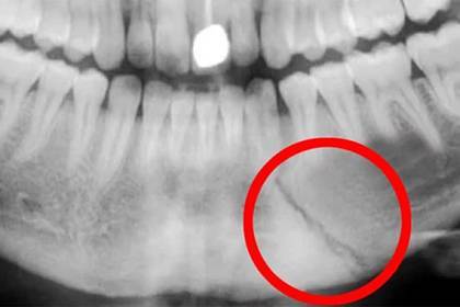 Рентгеновский снимок сломанной челюсти бойца UFC испугал фанатов