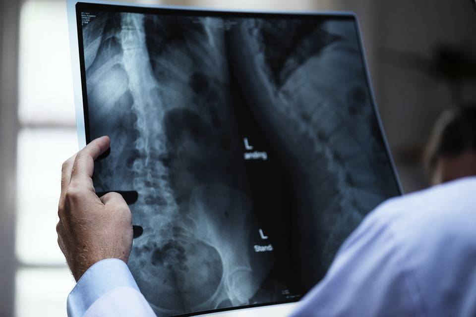 Медики придумали, как предотвратить остеопороз - Cursorinfo: главные новости Израиля
