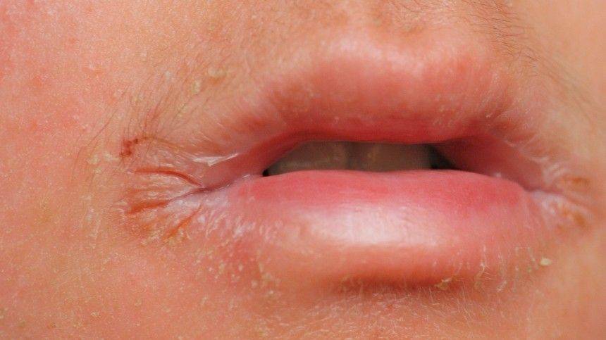 От инфекций до язвы: сухие губы назвали признаком серьезных заболеваний