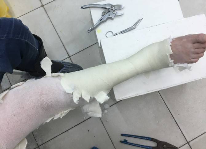 Самарские врачи заставили пациента снимать гипс плоскогубцами