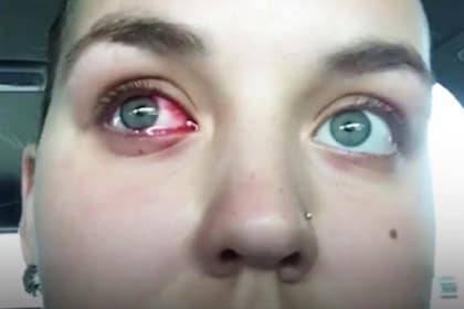 Загадочное заболевание заставило девушку плакать кровавыми слезами (фото)