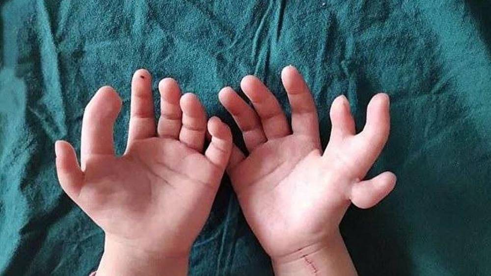 В Китае хирурги исправили руки девочки, родившейся с 14 пальцами