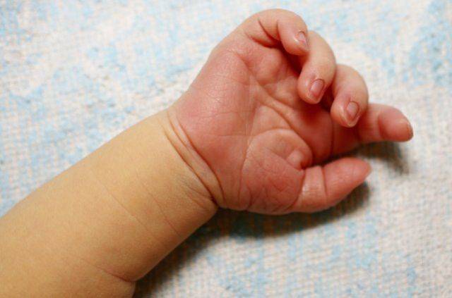 В Китае прооперировали девочку, родившуюся с 14-ю пальцами на руках