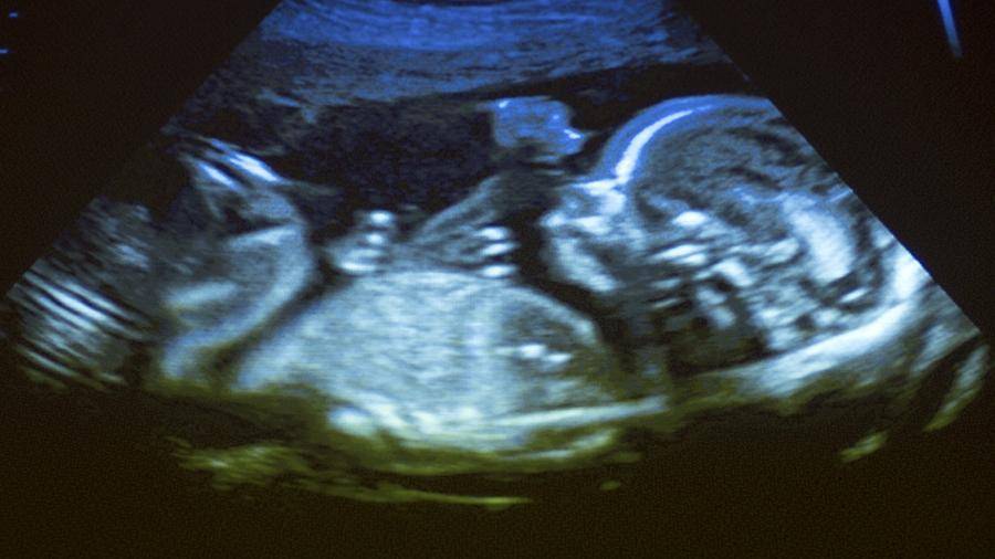В США заблокировали запрещающий аборты с шестой недели закон