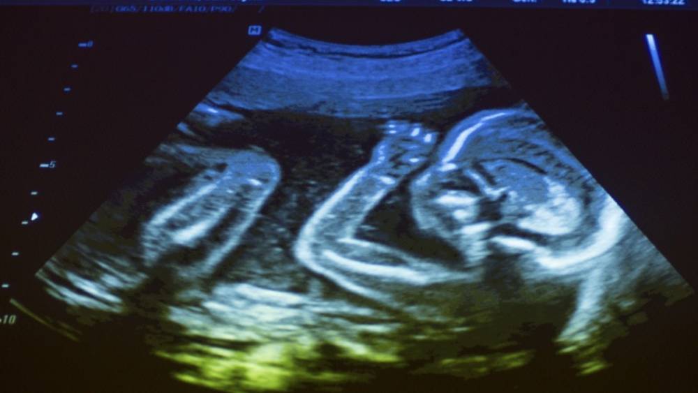 Американский суд заблокировал закон о запрете абортов, когда у младенца бьется сердце