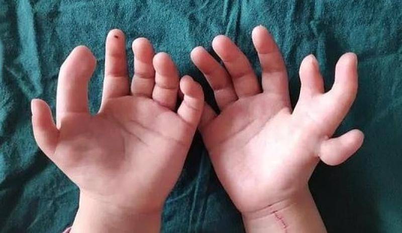 Китайские врачи удалили у трехлетней девочки четыре лишних пальца