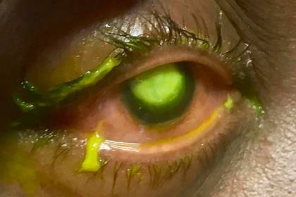 Пожирающие глаза бактерии расплодились из-за не снятой на ночь контактной линзы
