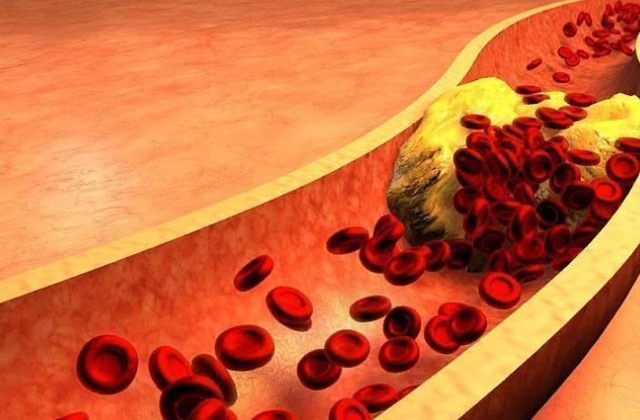 Медики предупреждают: Повышенный уровень холестерина сильно вредит сердцу