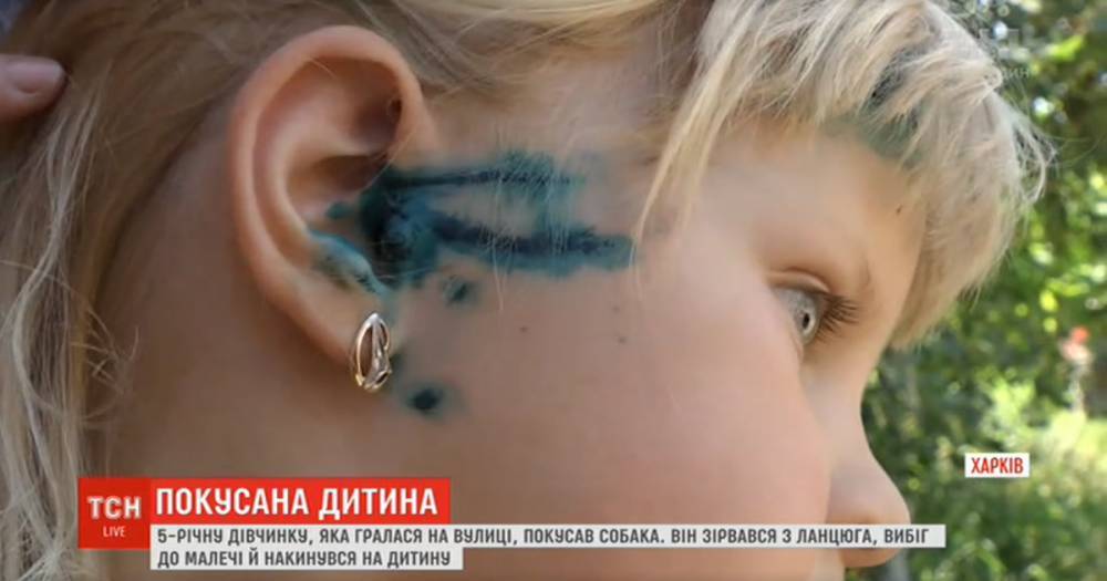 На Харьковщине пес напал на 5-летнего ребенка: искусал лицо