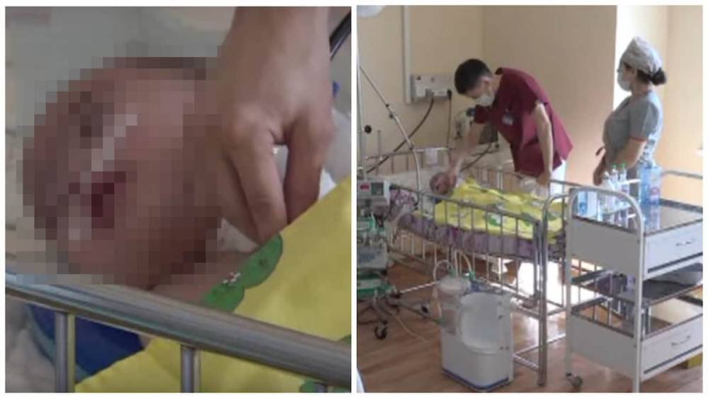 Пролежавшего в реанимации полтора года 2-летнего ребенка прооперировали в Нур-Султане