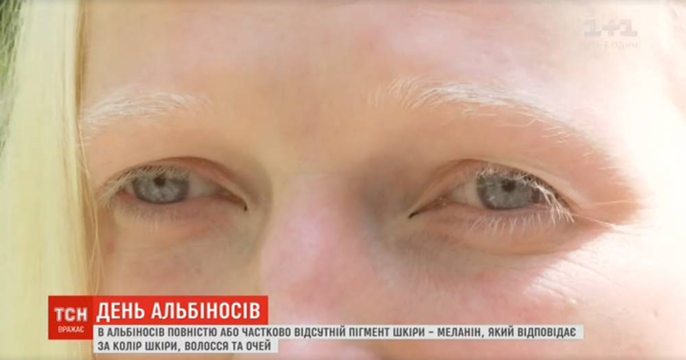 Поцелованные Богом люди: как живется альбиносам в Украине