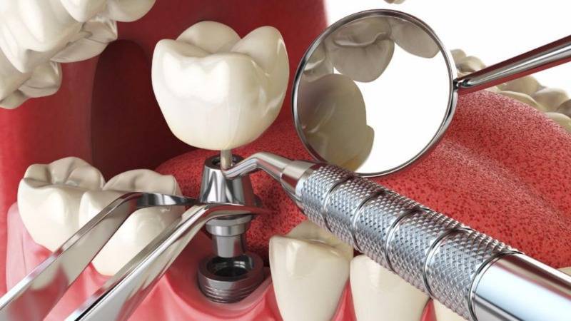 Сколько стоит зубной имплантат и какую часть возместит больничная касса?