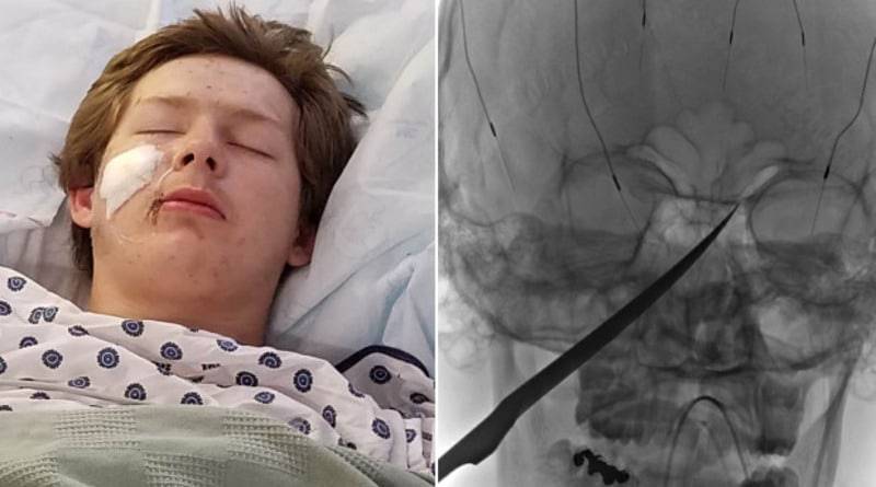 Чудесное спасение: подросток вонзил в череп 25-сантиметровый нож и выжил (фото)