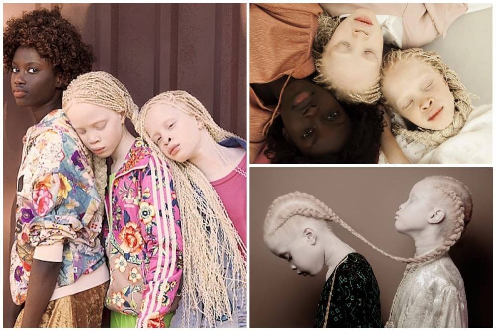 Сестры Бавар: как близнецы-альбиносы из Бразилии покоряют мир моды