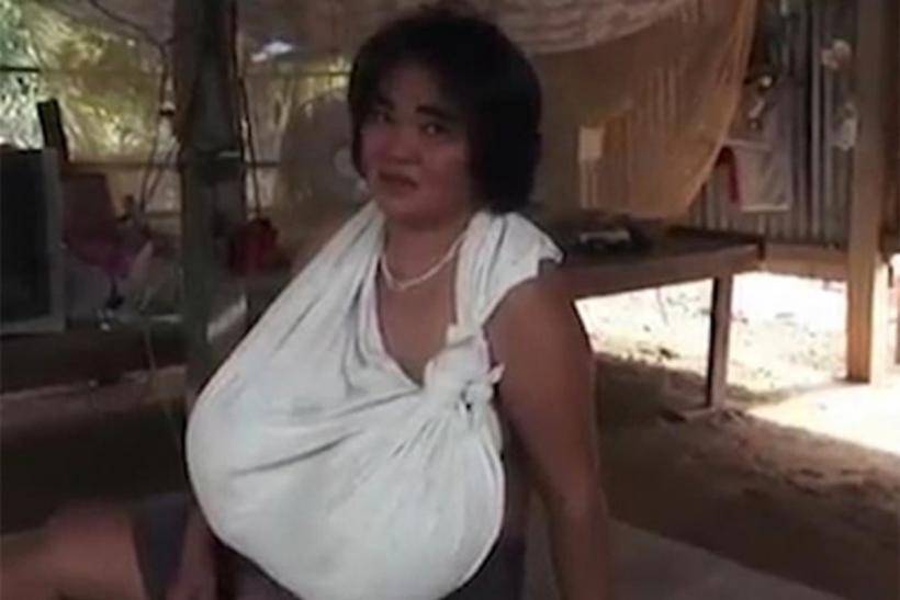 Неизвестное заболевание привело к аномальному увеличению груди у женщины из Таиланда