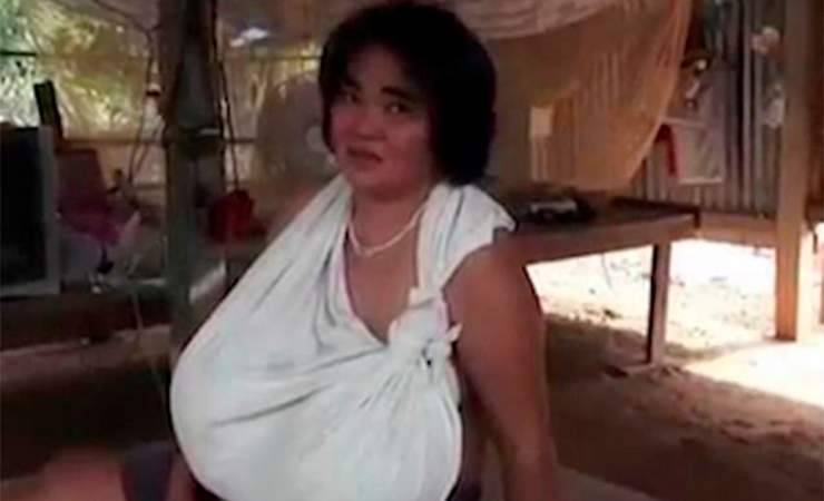Загадочная болезнь привела к аномальному росту груди у женщины в Тайланде
