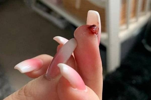 Женщина могла потерять часть пальца после того, как сделала себе акриловые ногти