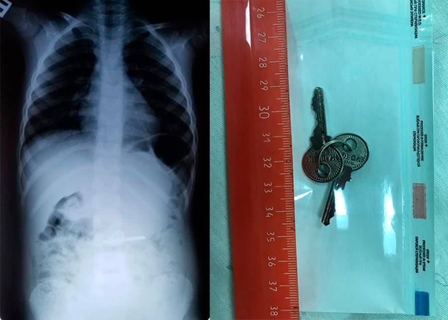Столичные врачи вытащили ключи из желудка ребенка