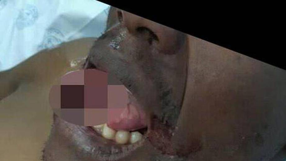 В ЮАР женщина‐врач откусила язык насильнику