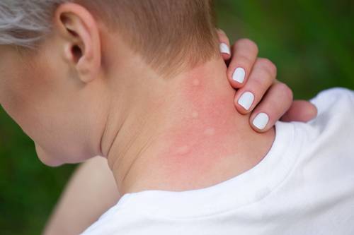 Комары, клопы, москиты: как лечить летние укусы в Израиле