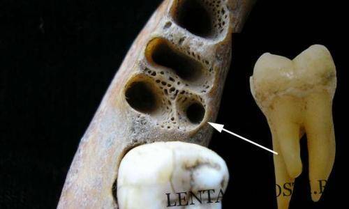 Нижние коренные зубы с тремя корнями достались жителям Азии от денисовцев