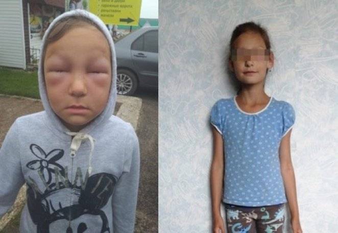 В Башкирии 8-летняя девочка находится в критическом состоянии из-за укусов пчел