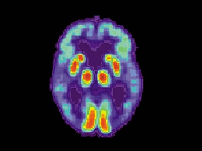 Связанный с болезнью Альцгеймера белок быстрее распространяется в мозге женщин