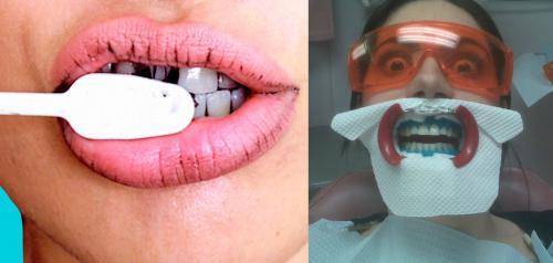 «Рай» для стоматолога — Кокосовый порошок для отбеливания сотрет эмаль «в ноль»